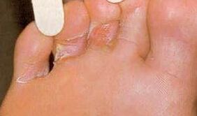 Lesiones de dermaid para la micosis del pie