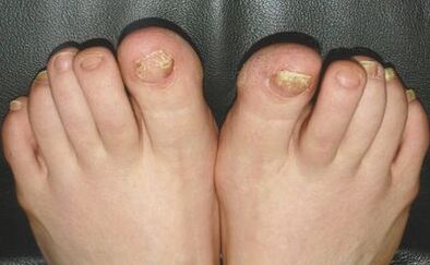 Signos de hongos en las uñas