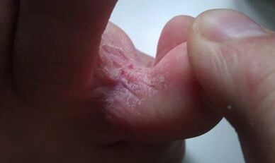 Etapas del desarrollo del hongo entre los dedos de los pies