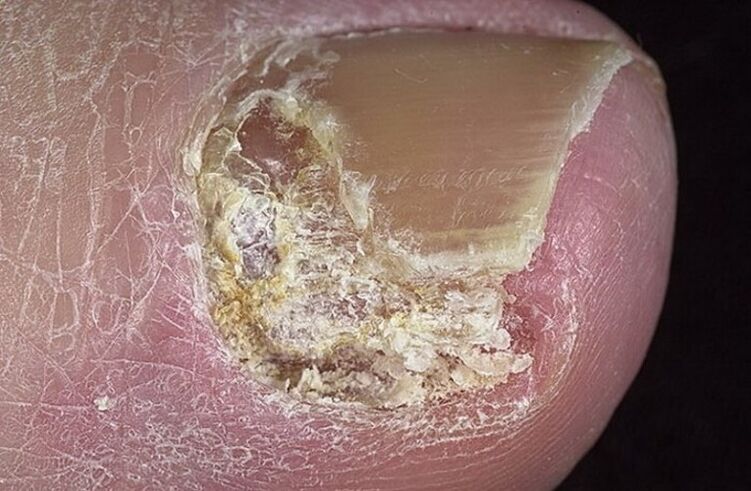 Tipos de onicomicosis
