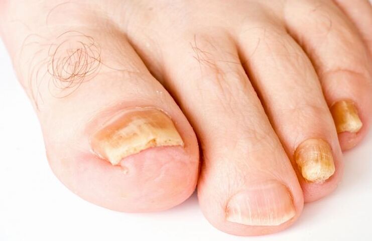 uñas de los pies amarillas debido a hongos