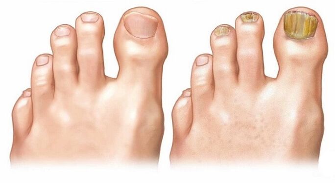 uñas sanas y hongos en las uñas de los pies